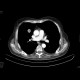 Grawitz tumor, renal cell carcinoma, metastatic disease: CT - Computed tomography